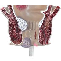 KyrenMed Modèle d'hémorroïde interne externe rectale humaine Modèle pathologique anorectal Modèle de lésion de fissure du rectum Taille réelle
