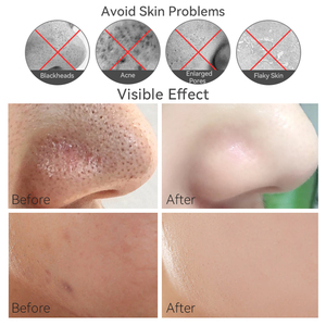Có thể sạc lại ABS lỗ chân không mụn đầu đen Remover Chăm Sóc Da thiết bị cho điều trị mụn trứng cá & trẻ hóa da làm săn chắc tính năng - Product Image 5