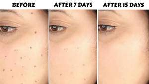 BAWEI boutons élimination des taches foncées acné <span class=keywords><strong>et</strong></span> détachant noir visage <span class=keywords><strong>et</strong></span> corps crème blanchissante <span class=keywords><strong>pour</strong></span> peau foncée - Product Image 4