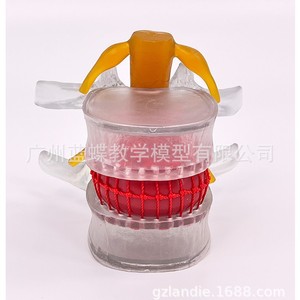 Modèle de démonstration de compression des disques intervertébraux lombaires humains, modèle d'agrandissement de la colonne vertébrale lombaire, colonne vertébrale pathologique - Product Image 2