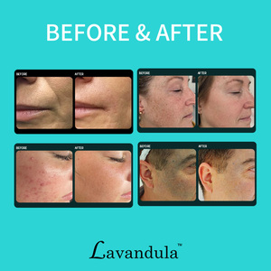 Лазер PZLASER Thulium 1927 нм, фракционный CO2-лазер 1927 нм для омоложения кожи и вагинального лифтинга, одобрен CE, для использования в салонах - Product Image 3