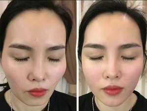 חומרי מילוי תת-עורית למקדשים, קפלי nasolabial וחדרי לחי - Product Image 3