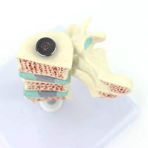 Osteoporose-Knochen modell-Zeigen Sie die normale/Osteopenie/osteoporo tische Knochen dichte mit abnehmbarem Wirbel - Product Image 2