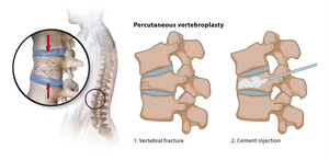 Ago professionale MOMO in titanio per puntura spinale per cifoplastica, vertebroplastica (PKP, PVP) di vertebre toraciche e lombari - Product Image 5