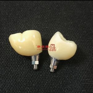 Impianto dentiere il modo migliore per trattare la perdita dei denti. Non danneggiare i denti adiacenti, evitare vicino al carico di forza del morso dei denti - Product Image 5
