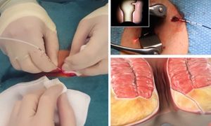 Diodo láser cirugía 980nm hemorroides pilas buasir hemorroides fístula láser ablación proctología láser - Product Image 6