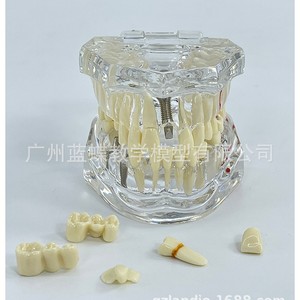 Modelo dental patológico transparente de boca completa para enseñanza médica, patología completa de los dientes, caries, odontología - Product Image 3