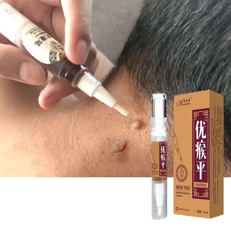 Skin Tag Remover gegen Mole & Genital Warze schnell entfernen innerhalb der Anti-Fuß-Mais entfernung Warzen Papillome schnell entfernt Maulwürfe