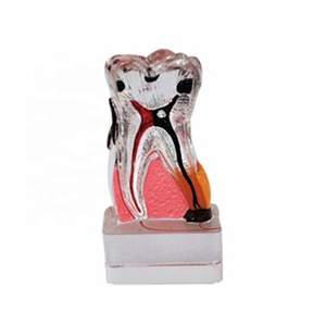 Modelo de enfermedad periodontal 4 veces modelo educativo de dientes - Product Image 1