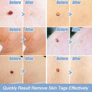 Thẻ Da Giết Nốt Ruồi Mụn Cơm Remover Micro Skin Auto Tag Removal Kit Với Làm Sạch Gạc Người Lớn Mole Mụn Cơm Chăm Sóc Mặt - Product Image 4
