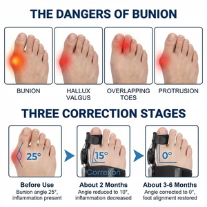 Corrector <span class=keywords><strong>de</strong></span> <span class=keywords><strong>Juanetes</strong></span> Ajustable <span class=keywords><strong>de</strong></span> Grado Médico al por Mayor con Hebilla Giratoria, Férula para Hallux Valgus, Certificación CE ISO FDA - Product Image 2