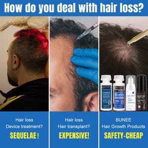 Nouveau Design Rogain Kit de mousse de croissance des cheveux 5% Romarin Menthe Cuir Chevelu Rogane Mousse capillaire Biotine Traitements de perte de cheveux pour hommes et femmes - Product Image 5