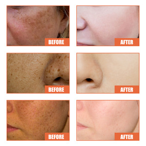 Crema facial efectiva <span class=keywords><strong>para</strong></span> blanquear manchas oscuras, pigmento alivia pecas, Corrector de <span class=keywords><strong>Melasma</strong></span>, belleza de la piel, OEM - Product Image 3