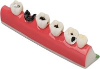 Modelo de desarrollo de caries dental de anatomía, modelos de dientes dentales para estudio de anatomía dental, educación de cuidado bucal y médico-paciente