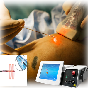 Dispositivo Láser de Lipólisis para Eliminación Vascular, Tratamiento de Venas Varicosas, Láser de Diodo EVLT de 980 1470nm, Máquina de Cirugía Estética - Product Image 1