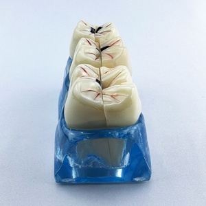 Modèle dentaire pathologique amovible 4 en 1 : Anatomie des caries, décomposition des dents, éducation et hygiène buccale polyvalente - Product Image 5