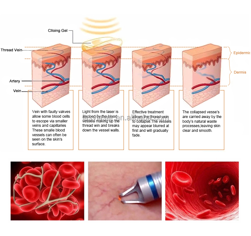 Máquina médica do laser do laser 980nm do diodo para a remoção da veia da aranha do laser 980 Diodo da remoção dos vasos sanguíneos e do rejuvenescimento da pele