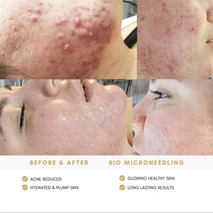 Chuyên Nghiệp Tảo Vỏ Sinh Học Microneedling Điều Trị Da Lột Điều Trị Mụn Trứng Cá Rong Biển Lột Bọt Biển Spicules Bọt Biển - Product Image 2