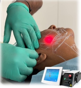 Máquina de Endoláser F-D-A para Rejuvenecimiento Facial, Láser de 650nm, 980nm y 1470nm, Máquina de Lipólisis Láser, Liposucción y Endolifting - Product Image 3