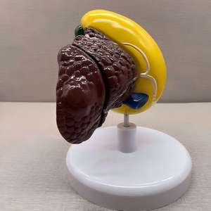 แบบจำลองการสอนเกี่ยวกับมะเร็งตับพร้อมฐาน - เครื่องมือกายวิภาคที่ถอดออกได้สำหรับการศึกษาโรคตับ - Product Image 3