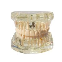 Modèle dentaire amovible de pont de restauration de dents modèle de maladie de dent d'implant