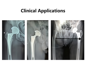 Sistema de Reemplazo <span class=keywords><strong>Total</strong></span> de Cadera Anatómico Profesional de Grado Médico Sin Cemento, Implantes Quirúrgicos de Titanio con Recubrimiento de HA para Fracturas - Product Image 4