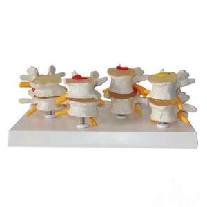 Gelsonlab HSBM-134 4 Stadiumwervels Menselijk Anatomisch Model Lendenwervel Wervel Zieke Osteoporose Wervels Model - Product Image 2