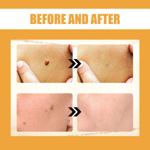 ¡Novedad de 2025! Eliminación de verrugas, queratosis, especialmente formulada para desvanecer las etiquetas de la piel, manchas, cuidado corporal - Product Image 5