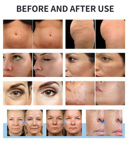 2026 Trendprodukt Morph 8 Dehnungsstreifen-Entfernung Hautregeneration Jet Peel <span class=keywords><strong>RF</strong></span>-Microneedling-Gerät Anti-Aging Schönheitsausrüstung - Product Image 5