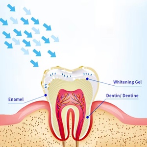 Lámpara LED Azul para Blanqueamiento Dental, Dispositivo Portátil de Blanqueamiento Dental con Luz Azul Fría - Product Image 5