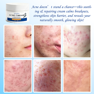 Crème de traitement de l'acné à base de plantes avec ginseng, lavande et menthe poivrée, réduit <span class=keywords><strong>les</strong></span> <span class=keywords><strong>rougeurs</strong></span> et l'inflammation, renforce la barrière cutanée, atténue <span class=keywords><strong>les</strong></span> marques d'acné - Product Image 5