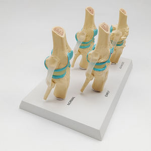 Modelo Anatómico de <span class=keywords><strong>Esqueleto</strong></span> <span class=keywords><strong>Humano</strong></span> de Tamaño Real, Modelo de Articulación de <span class=keywords><strong>Rodilla</strong></span> Enferma en 4 Etapas para Enseñanza - Product Image 3