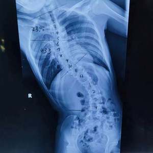 Système de surveillance neurologique intraopératoire (PIOM) à 32 canaux, surveillance neurophysiologique, EMG, tubes endotrachéaux - Product Image 5