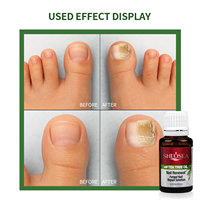 Solution de réparation des ongles 100% naturelle et biologique à base de plantes, avec huile essentielle d'arbre à thé, pour ongles décolorés et abîmés