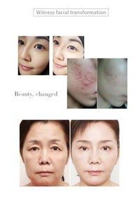 2025 Dep Dermo Electro Poration Système pour Visage Mains Tête Mésothérapie Élimine Les Rides Resserre La Peau Disponible AU US IT ZA - Product Image 5