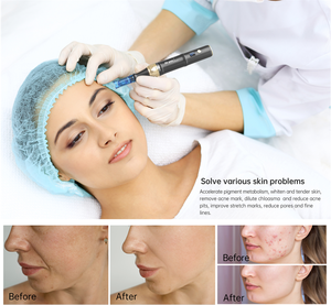 <strong>Dr</strong> <strong>Pen</strong> <strong>A8S</strong> MTS <strong>Ultima</strong> Derma <strong>Pen</strong> Skin Rejuvenation Micro Needles Cartridges Electric Microneedling Machine - Product Image 3