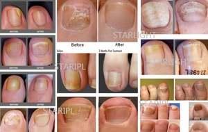 Alat <span class=keywords><strong>Laser</strong></span> perawatan kuku jamur untuk jamur kuku 980m penghilang jamur kuku Anti infeksi podiatri perawatan onikomikosis - Product Image 6