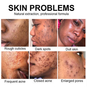 Turmeric Glow Combo Double-Glutathio Kojic Acid Whitening Dark Spot Anti Acné Skin Care Set para revelar la piel radiante - Product Image 2