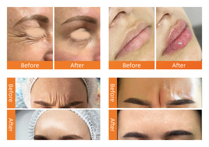 Gel d'<span class=keywords><strong>acide</strong></span> <span class=keywords><strong>hyaluronique</strong></span> réticulé injectable en gros pour comblement des lèvres et hydratation du visage, usage féminin - Product Image 5