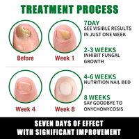 Sérum Traitant Efficace et Puissant pour les Mycoses des Ongles en 7 Jours – Solution Réparatrice et Nourrissante pour Ongles Abîmés – Huile Naturelle à Base de Plantes pour les Ongles