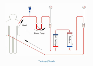 ทางการแพทย์ปกติเลือดบริสุทธิ์ผลิตภัณฑ์ทางการแพทย์ทิ้ง Hemoperfusion ตลับ - Product Image 4