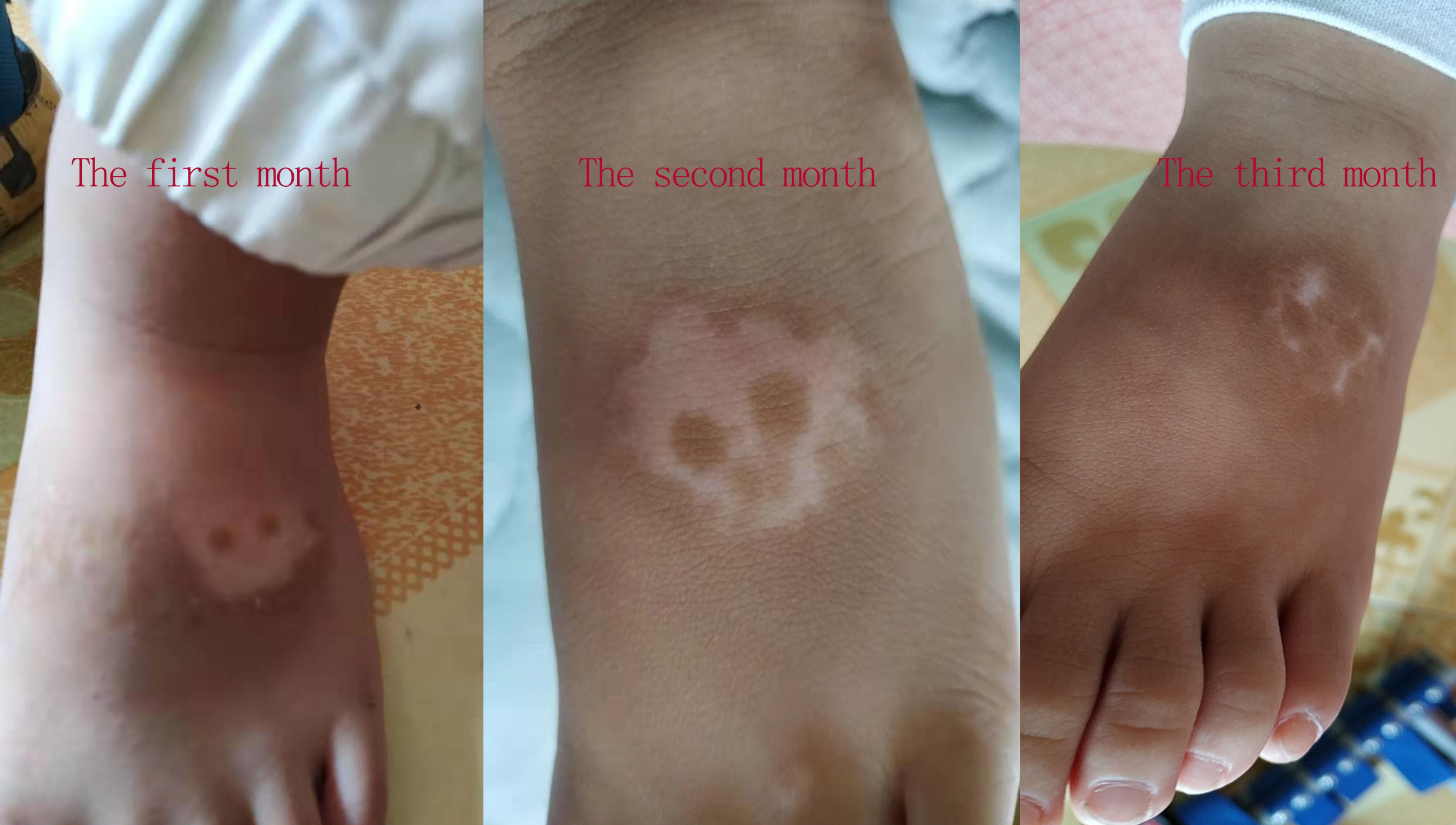 uvb test lamp scalp psoriasis treatment 311nm Uvb Lamp