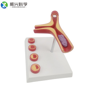 Modelo de arteria en forma de Y con aterosclerosis y trombosis, modelo educativo, suministros del fabricante. - Product Image 3