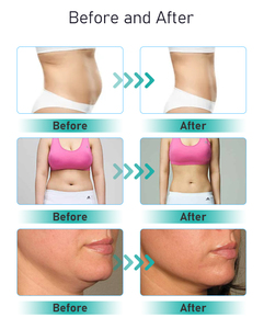Máquina de Adelgazamiento Abdominal 3 en 1 con Tecnología Patentada de Radiofrecuencia Plana, Ultrasonido para Reafirmar la <span class=keywords><strong>Piel</strong></span>, Lipo Ultrasónico de 80k y Eliminación de Puntos Negros - Product Image 4