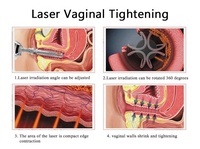 Co2 10600nm Láser fraccional Eliminación de acné Eliminación de cicatrices Eliminación de verrugas Tratamiento vaginal Rejuvenecimiento DE LA PIEL Láser fraccional Co2