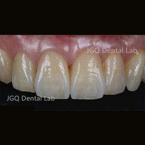 Couronne et ponts personnalisables en céramique de porcelaine à haute résistance de zircone pour les <span class=keywords><strong>dents</strong></span> antérieures et postérieures - Product Image 1