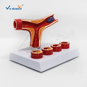 Modelo de Trombosis, Modelo Anatómico de <span class=keywords><strong>Arteriosclerosis</strong></span> Cardiovascular Humana - Product Image 6