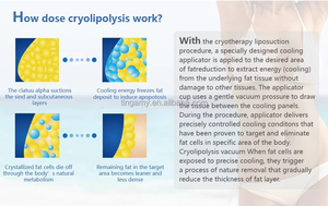Macchina Professionale per Criolipolisi a 360° con Doppio Manipolo, Rimozione del Grasso con Lipo Laser - Product Image 6