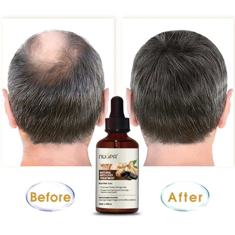 NUSPA Private Label Herbal Organic Vegan Anti Hair Loss Treatment Hair Growth Oil for Bald Hair