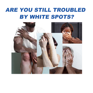 Crème de soin corporel en gros OEM/ODM pour la réparation du <span class=keywords><strong>vitiligo</strong></span>, tube de 20g, adapté aux adultes - Product Image 2